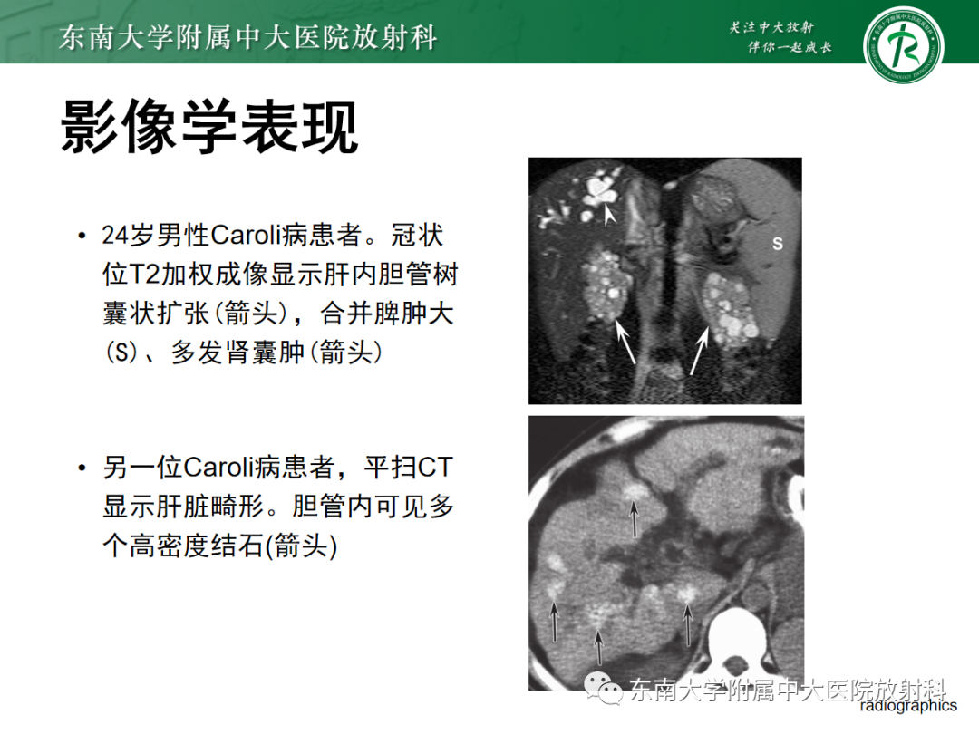 影像PPT - 【PPT】Caroli病-19 影像PPT - 【PPT】Caroli病-19