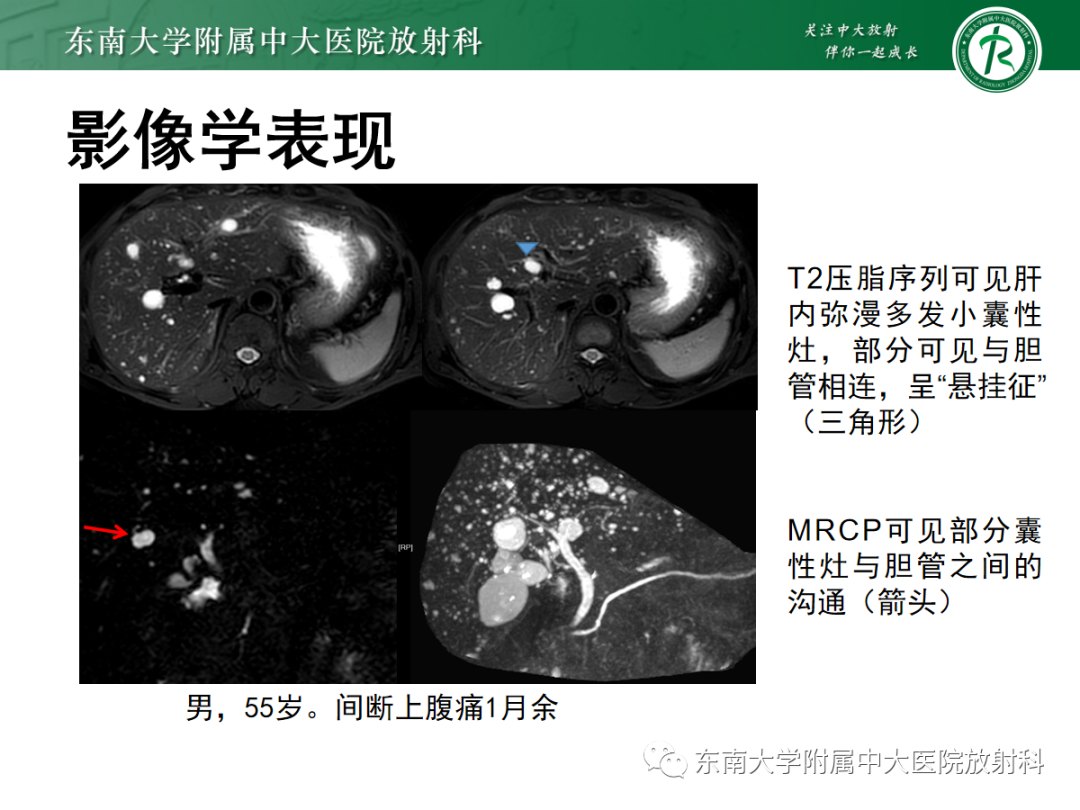 影像PPT - 【PPT】Caroli病-20 影像PPT - 【PPT】Caroli病-20