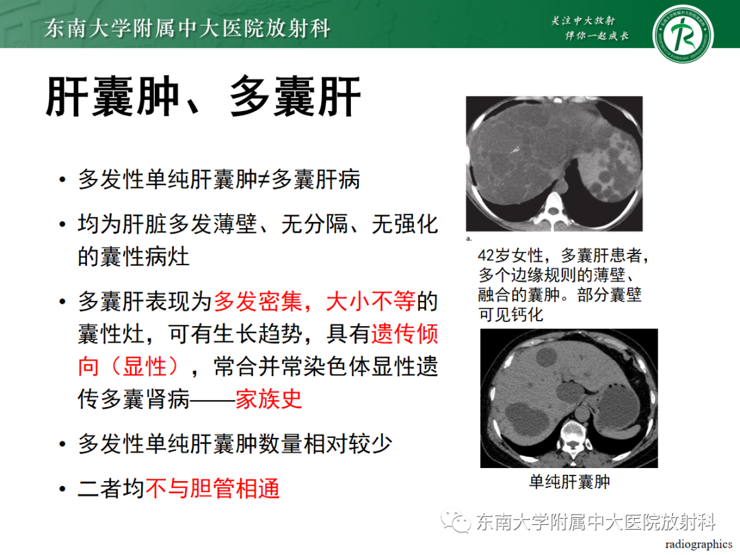 影像PPT - 【PPT】Caroli病-22 影像PPT - 【PPT】Caroli病-22