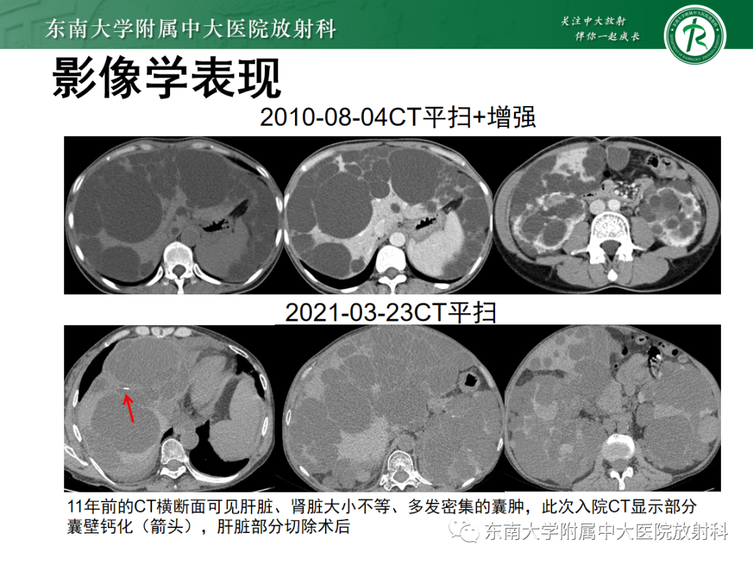 影像PPT - 【PPT】Caroli病-23 影像PPT - 【PPT】Caroli病-23