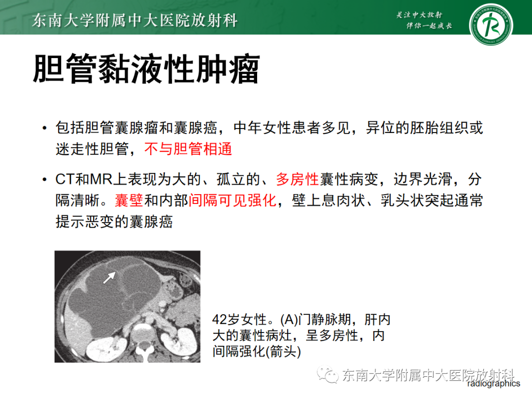 影像PPT - 【PPT】Caroli病-25 影像PPT - 【PPT】Caroli病-25