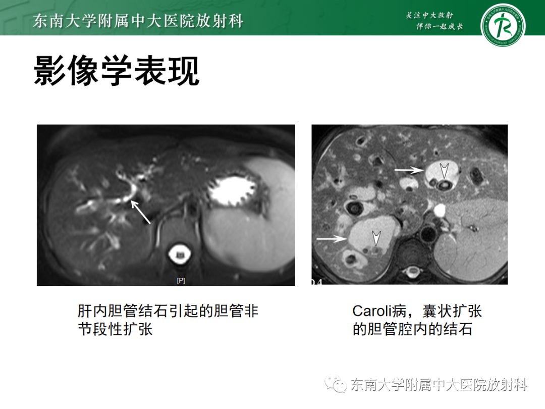 影像PPT - 【PPT】Caroli病-28 影像PPT - 【PPT】Caroli病-28