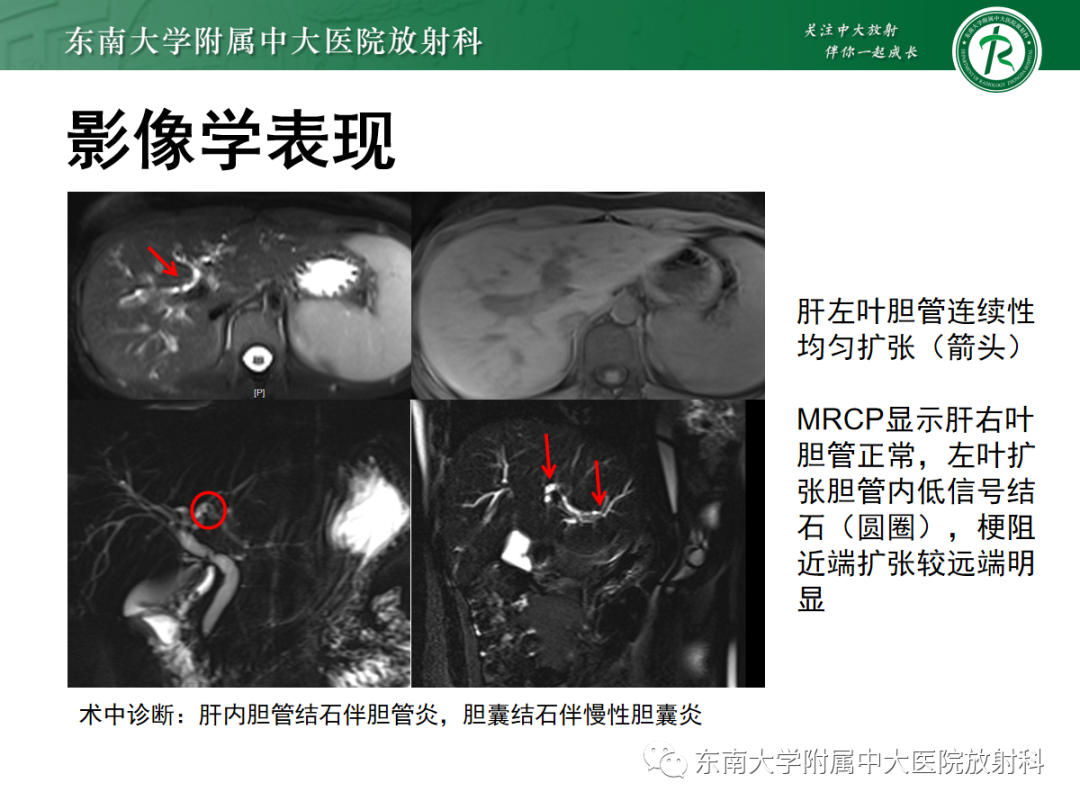 影像PPT - 【PPT】Caroli病-29 影像PPT - 【PPT】Caroli病-29