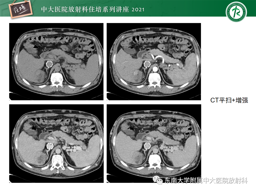 影像PPT - 【PPT】肝脏常见含脂病变-2