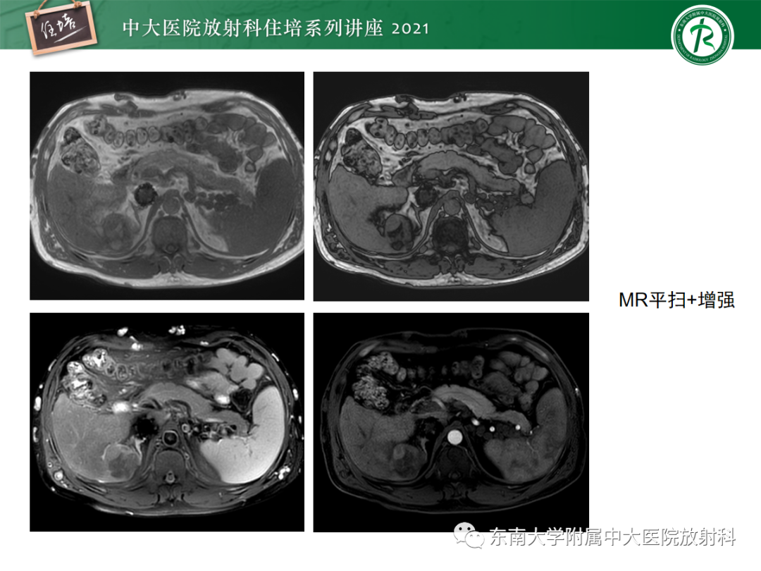 影像PPT - 【PPT】肝脏常见含脂病变-3