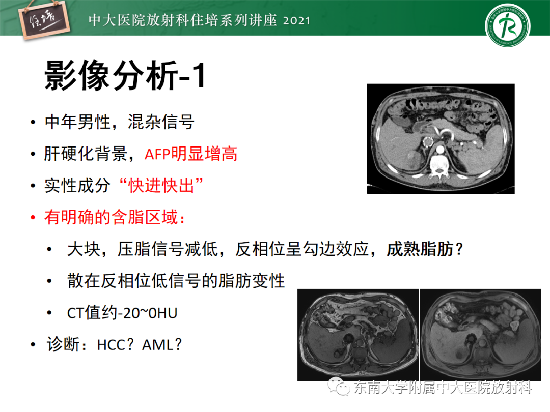 影像PPT - 【PPT】肝脏常见含脂病变-4