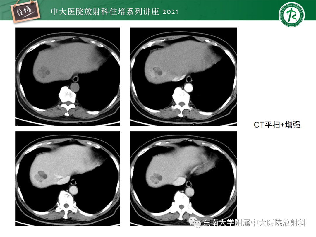 影像PPT - 【PPT】肝脏常见含脂病变-6