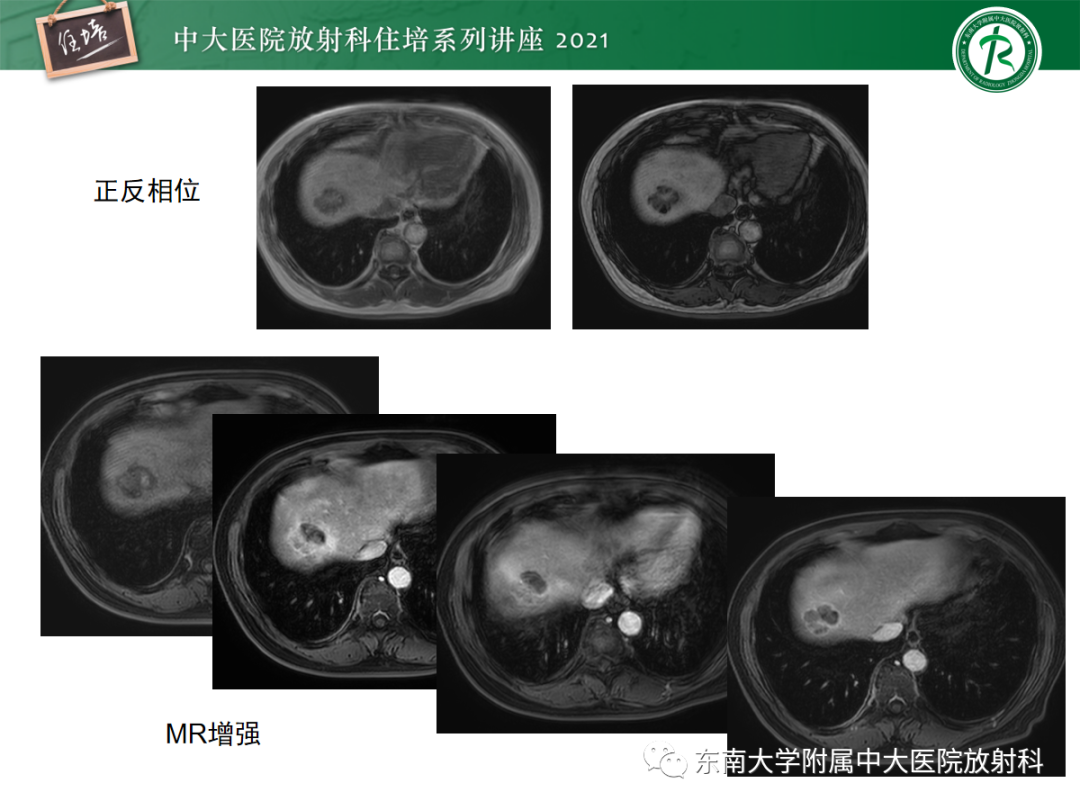影像PPT - 【PPT】肝脏常见含脂病变-7
