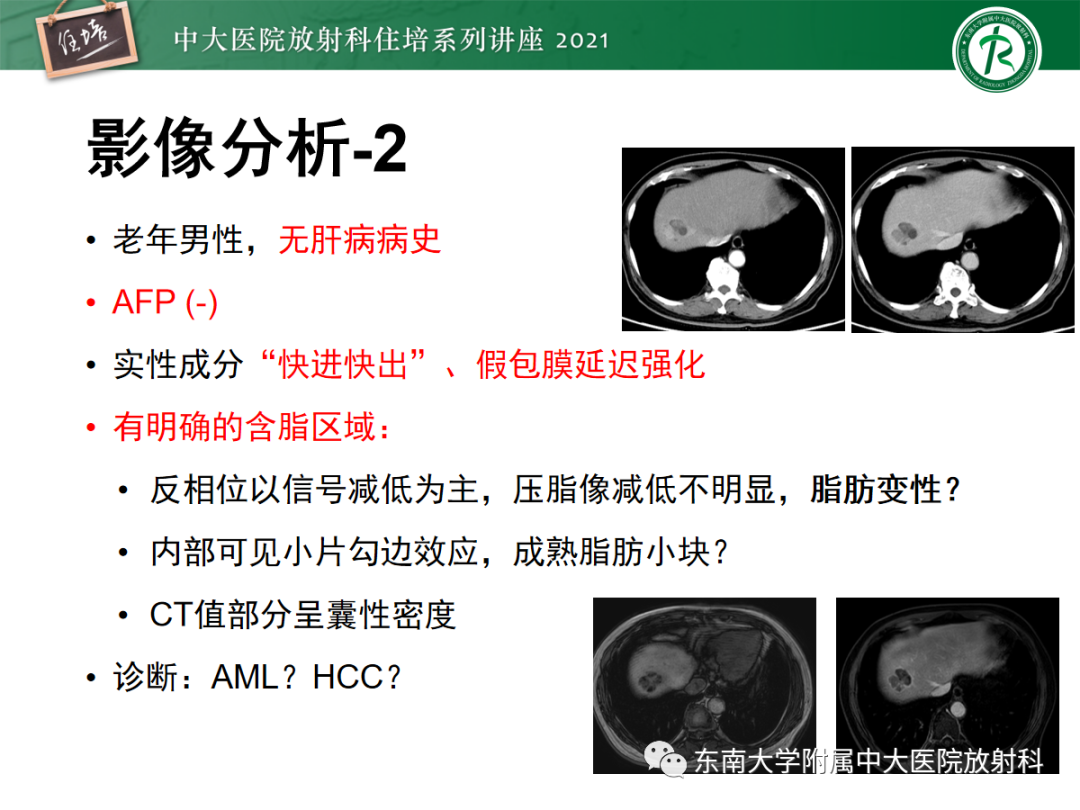 影像PPT - 【PPT】肝脏常见含脂病变-8