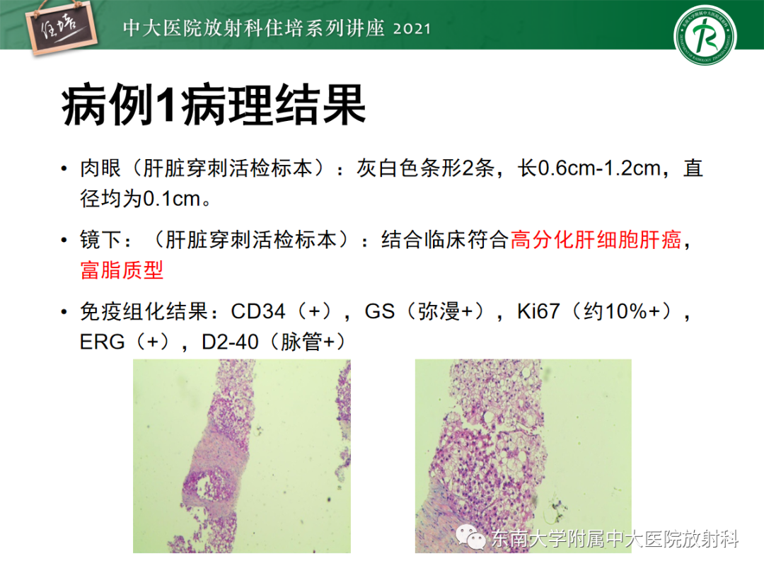 影像PPT - 【PPT】肝脏常见含脂病变-9