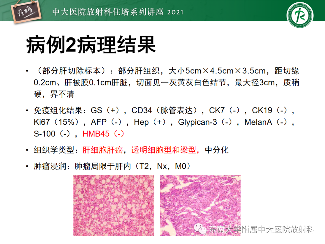 影像PPT - 【PPT】肝脏常见含脂病变-10