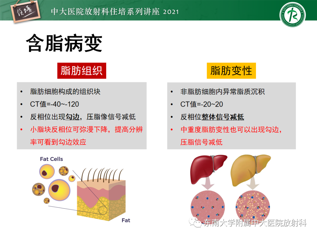 影像PPT - 【PPT】肝脏常见含脂病变-12