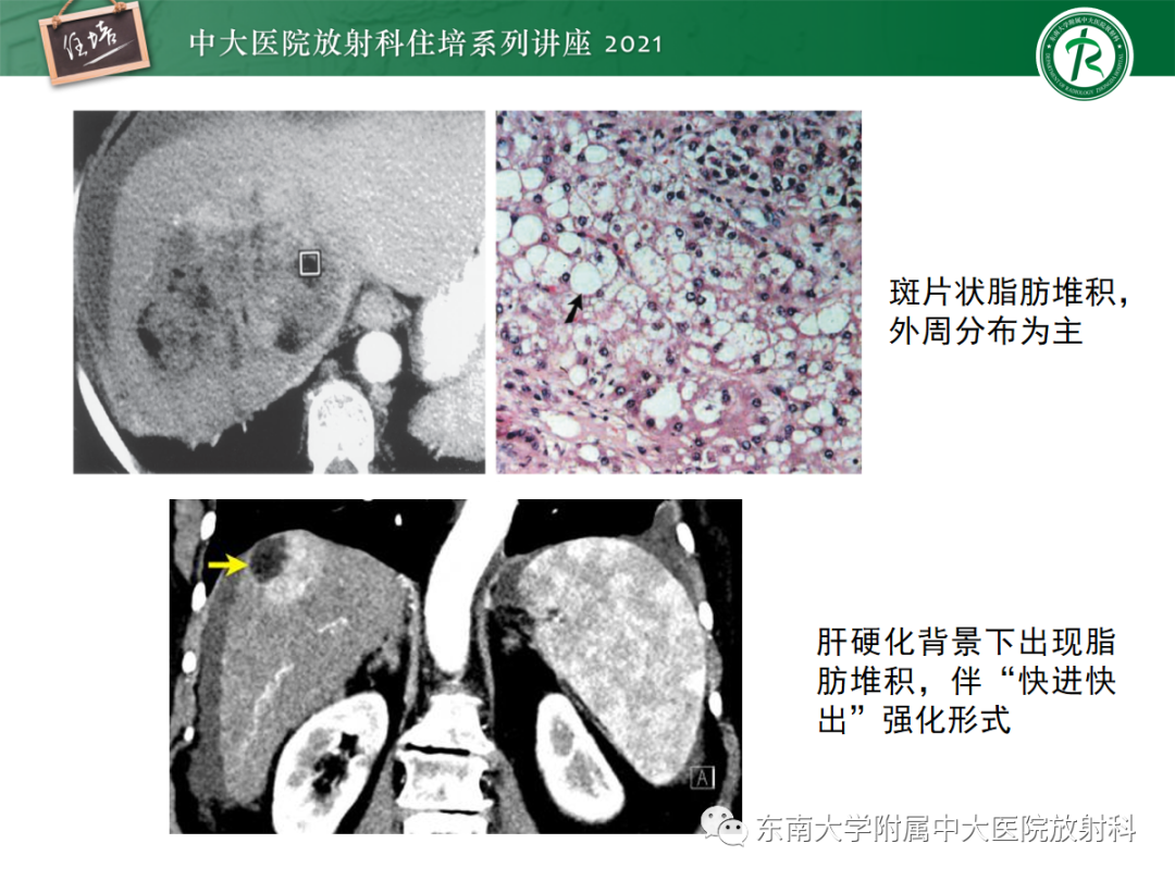 影像PPT - 【PPT】肝脏常见含脂病变-19