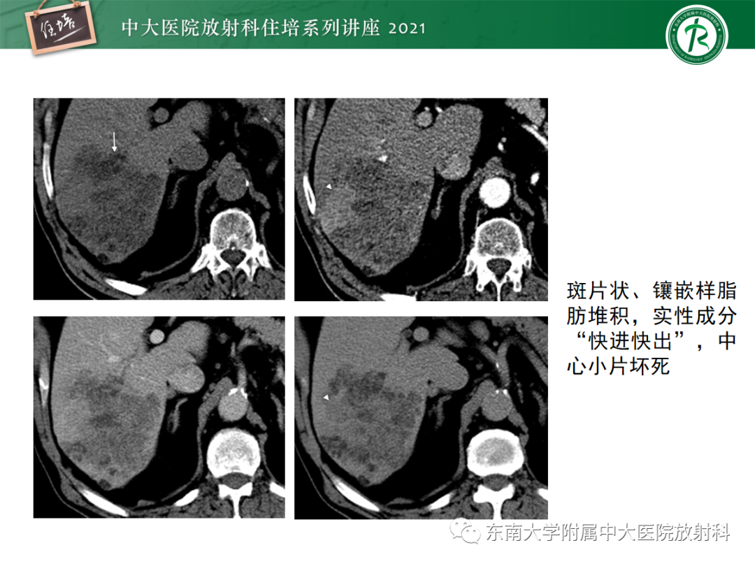 影像PPT - 【PPT】肝脏常见含脂病变-18