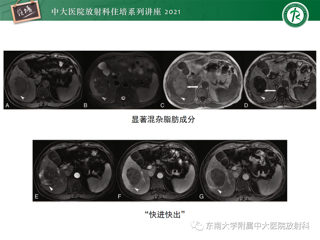 影像PPT - 【PPT】肝脏常见含脂病变-20