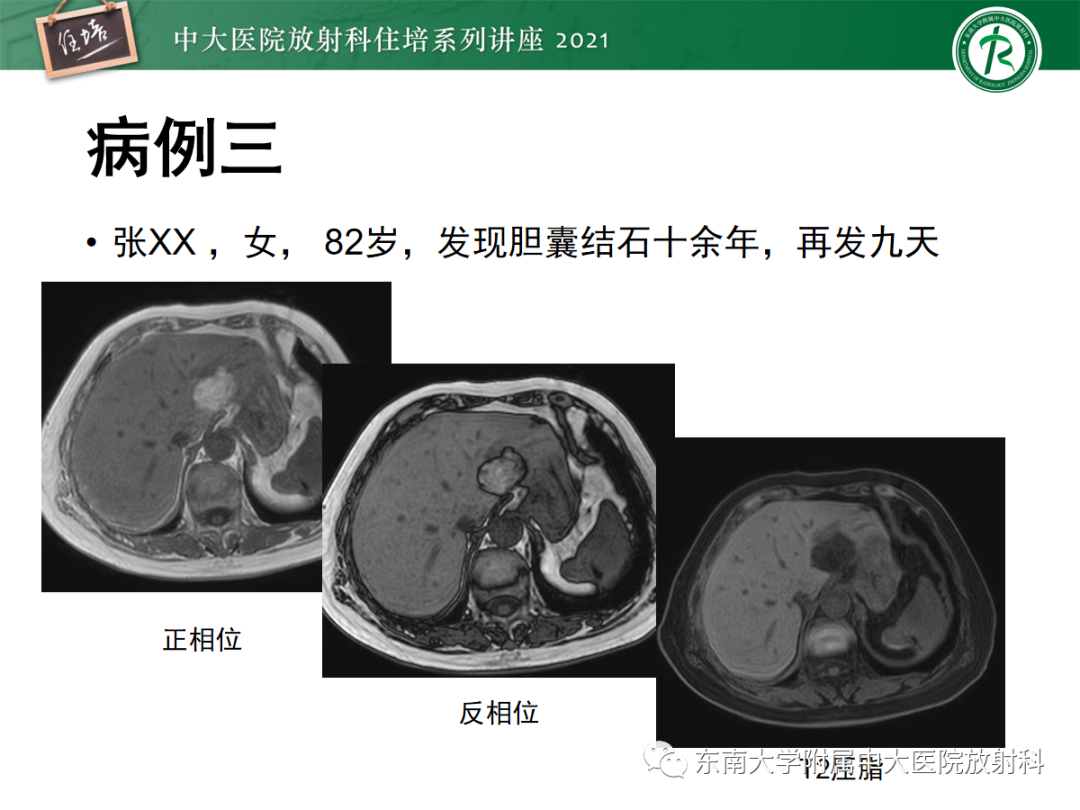 影像PPT - 【PPT】肝脏常见含脂病变-24