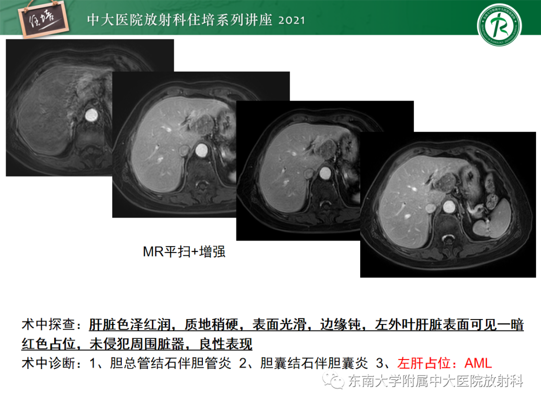 影像PPT - 【PPT】肝脏常见含脂病变-25