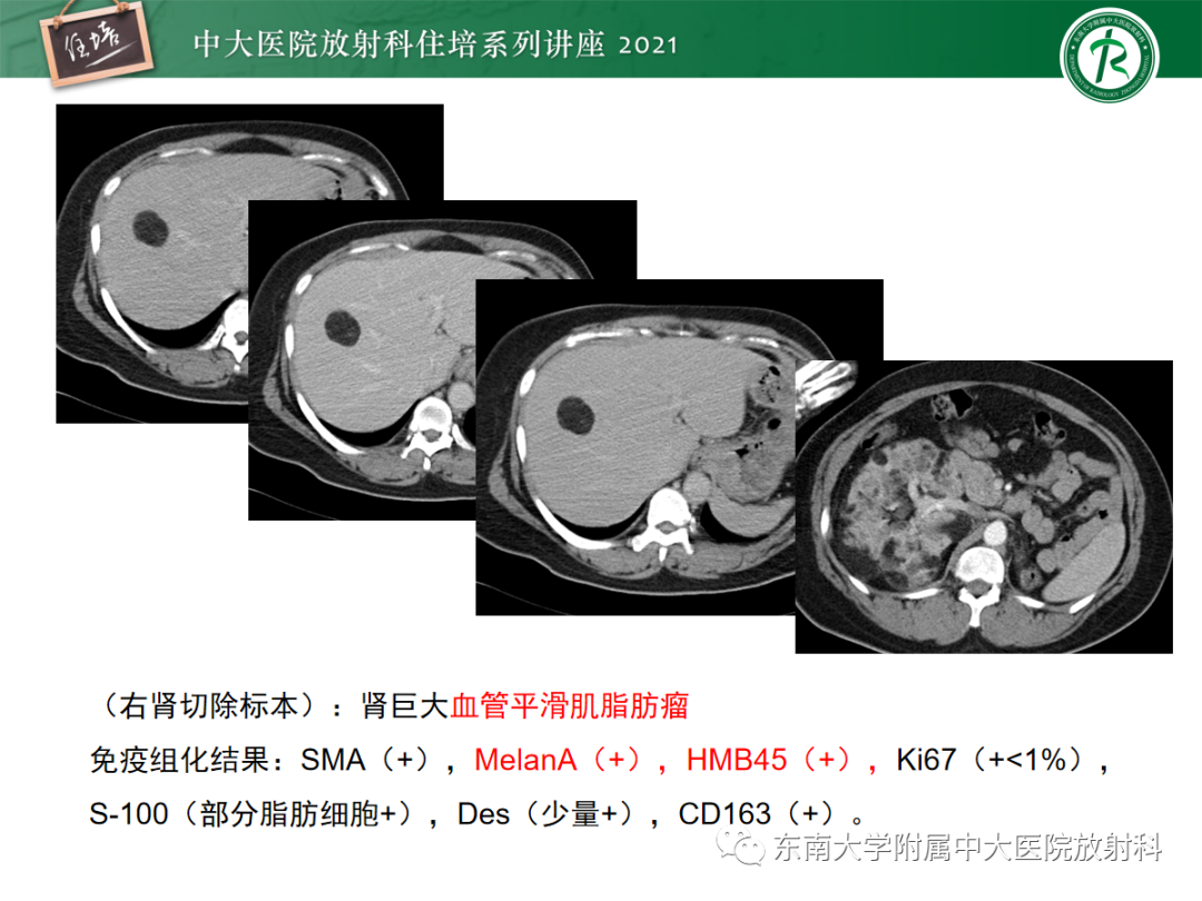 影像PPT - 【PPT】肝脏常见含脂病变-27