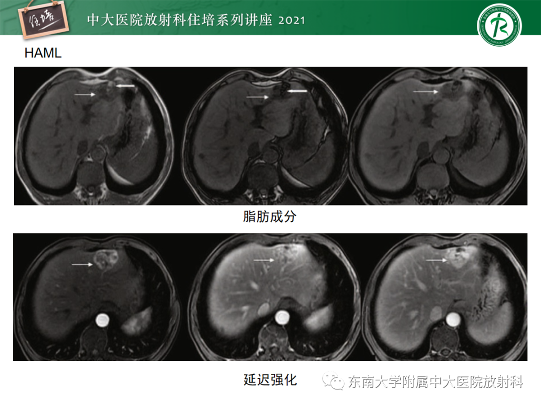 影像PPT - 【PPT】肝脏常见含脂病变-29