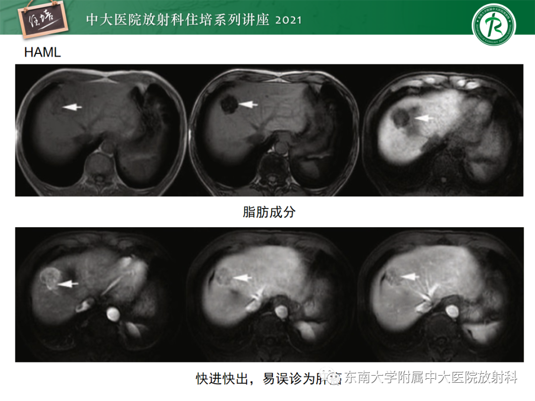 影像PPT - 【PPT】肝脏常见含脂病变-30