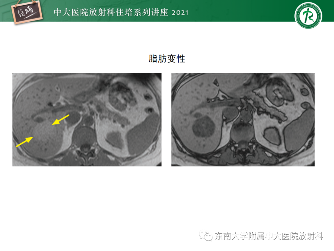 影像PPT - 【PPT】肝脏常见含脂病变-35