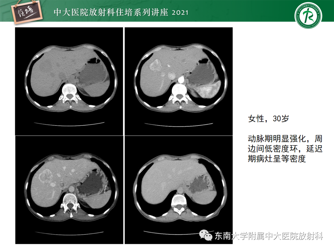 影像PPT - 【PPT】肝脏常见含脂病变-36