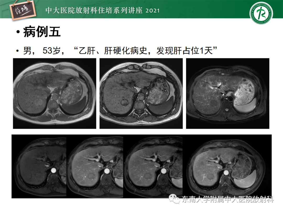 影像PPT - 【PPT】肝脏常见含脂病变-38