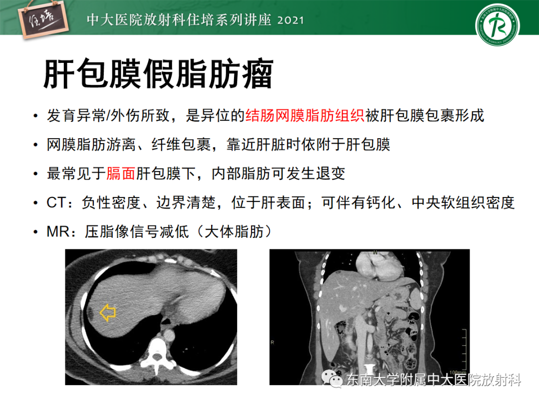 影像PPT - 【PPT】肝脏常见含脂病变-40