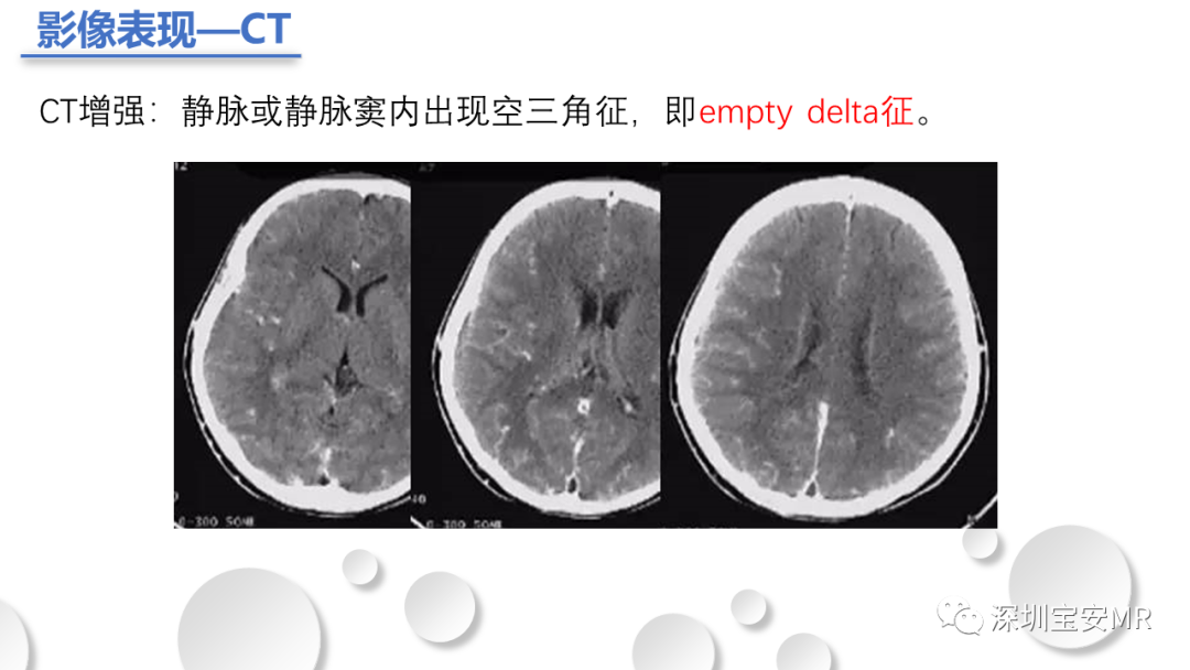 影像PPT - 【PPT】颅内静脉和静脉窦血栓形成-12
