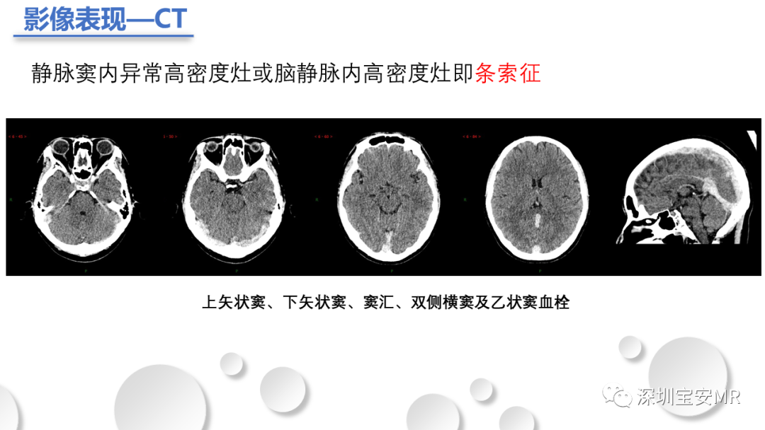 影像PPT - 【PPT】颅内静脉和静脉窦血栓形成-11