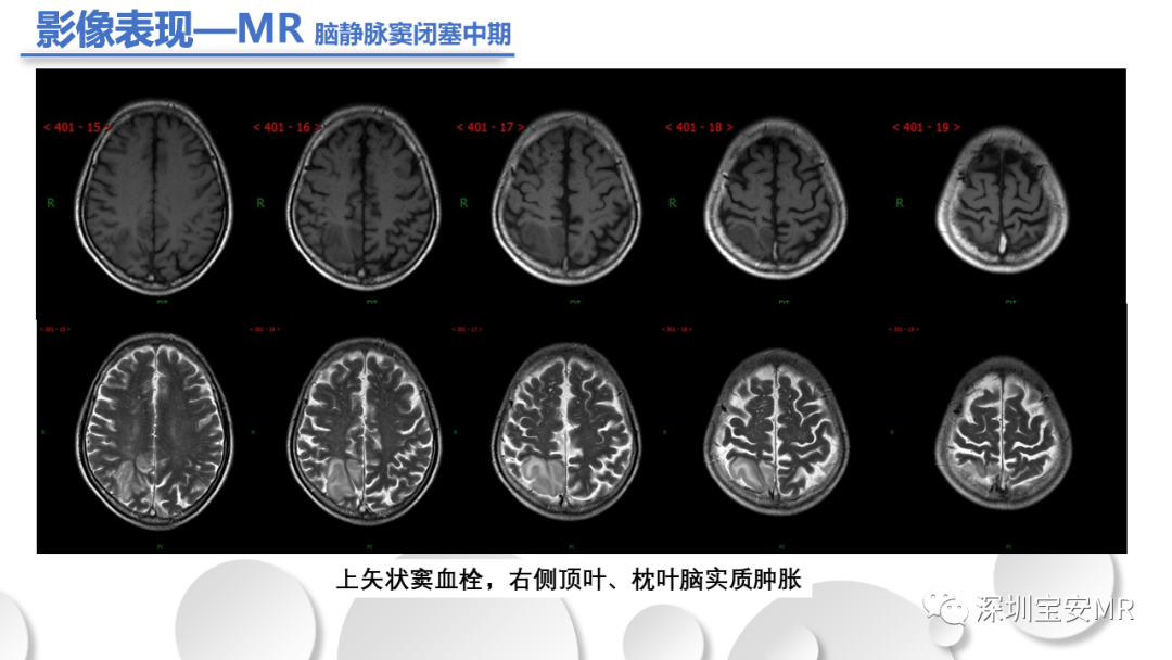 影像PPT - 【PPT】颅内静脉和静脉窦血栓形成-15