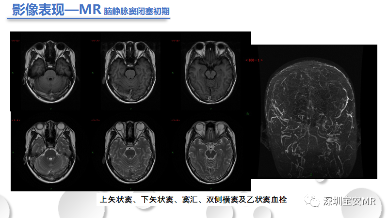 影像PPT - 【PPT】颅内静脉和静脉窦血栓形成-14