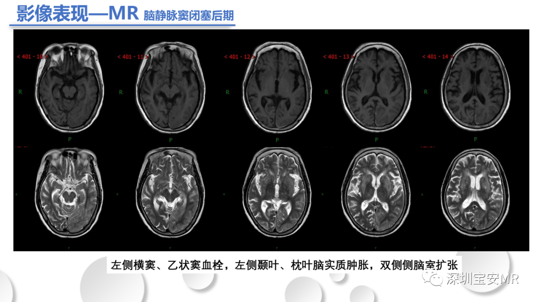影像PPT - 【PPT】颅内静脉和静脉窦血栓形成-16
