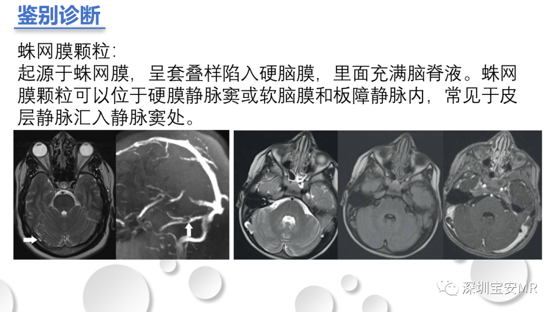影像PPT - 【PPT】颅内静脉和静脉窦血栓形成-19