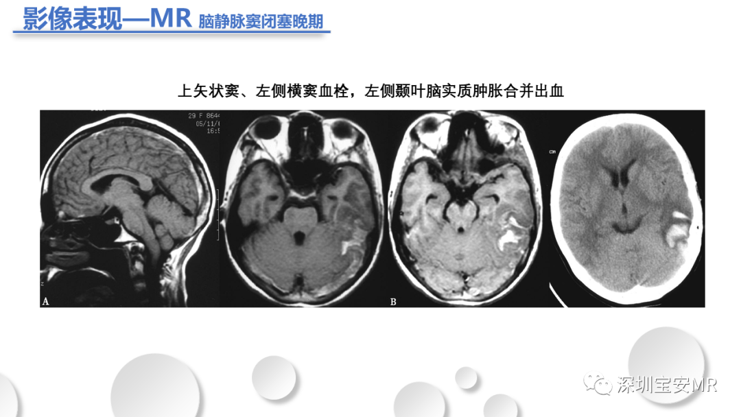 影像PPT - 【PPT】颅内静脉和静脉窦血栓形成-17