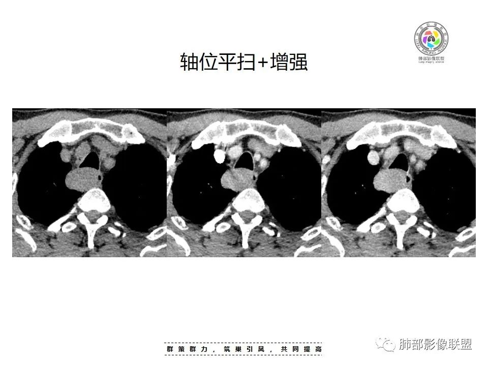 影像PPT - 【病例】罕见的食管神经鞘瘤-7