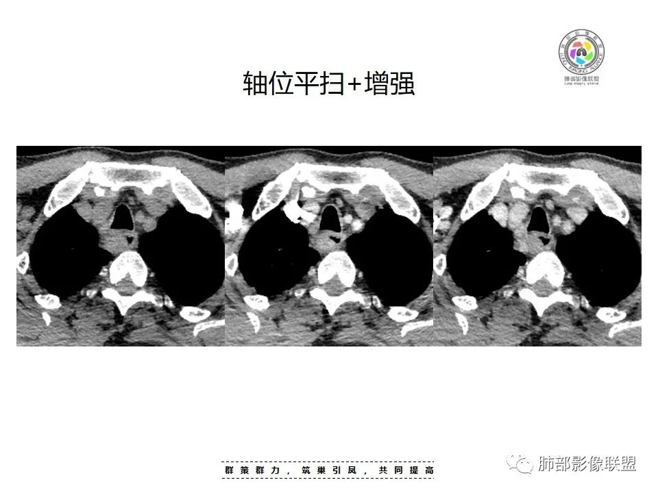 影像PPT - 【病例】罕见的食管神经鞘瘤-8