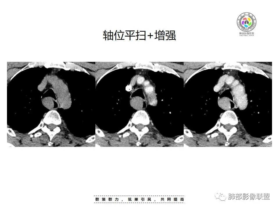 影像PPT - 【病例】罕见的食管神经鞘瘤-10