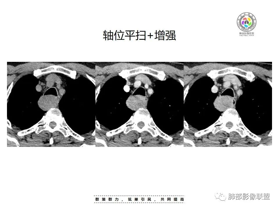 影像PPT - 【病例】罕见的食管神经鞘瘤-9