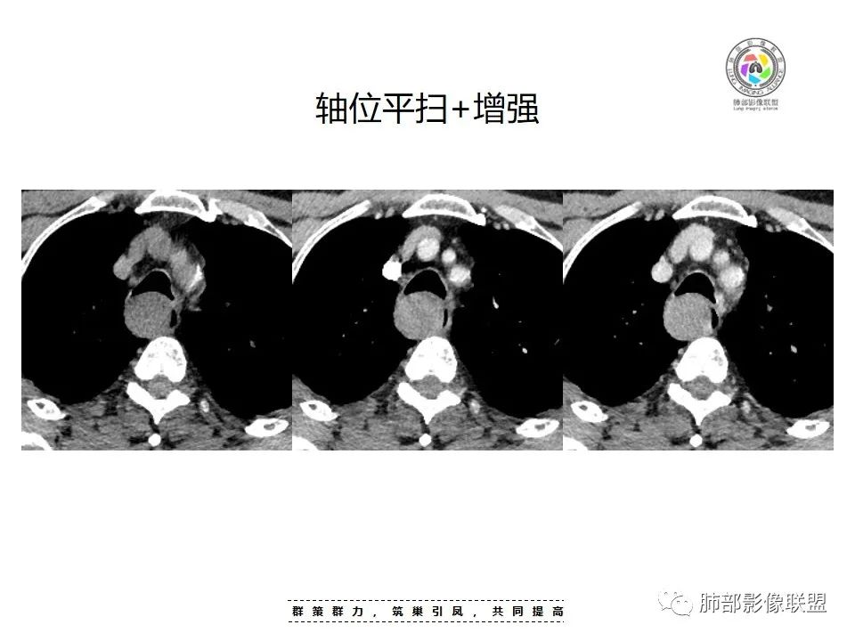 影像PPT - 【病例】罕见的食管神经鞘瘤-11