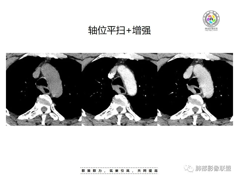 影像PPT - 【病例】罕见的食管神经鞘瘤-12
