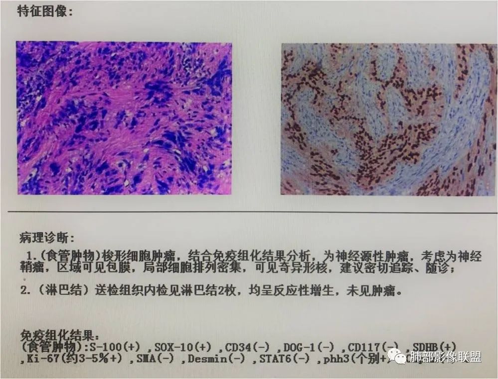 影像PPT - 【病例】罕见的食管神经鞘瘤-23