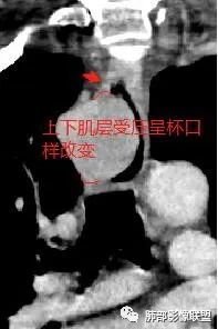 影像PPT - 【病例】罕见的食管神经鞘瘤-26