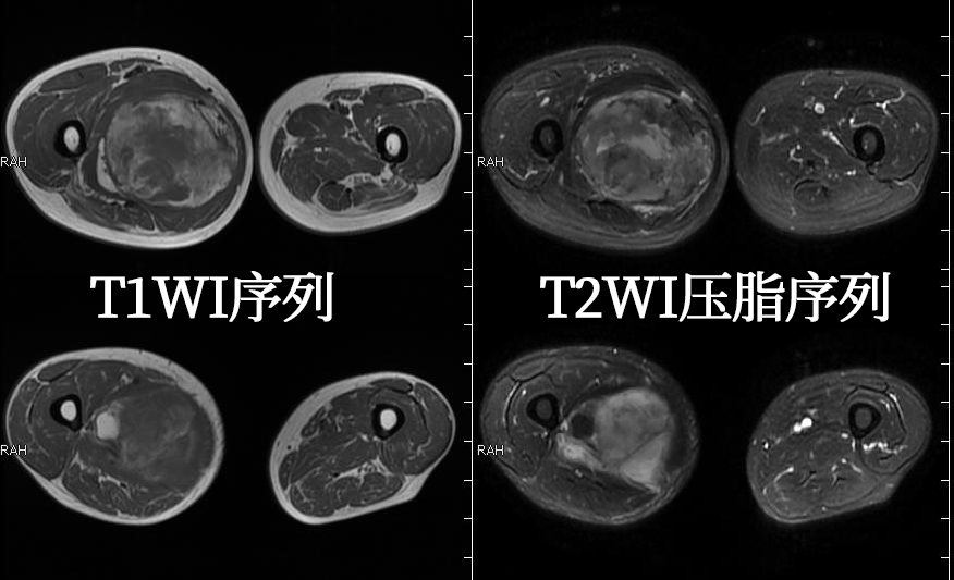 影像PPT - 脂肪肉瘤的影像表现-8 影像PPT - 脂肪肉瘤的影像表现-8