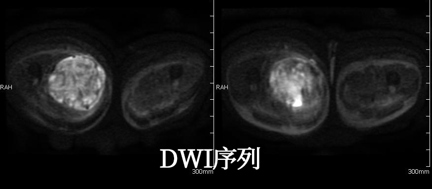 影像PPT - 脂肪肉瘤的影像表现-9 影像PPT - 脂肪肉瘤的影像表现-9
