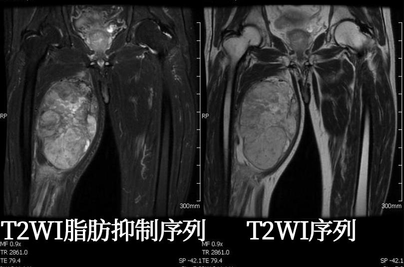 影像PPT - 脂肪肉瘤的影像表现-10 影像PPT - 脂肪肉瘤的影像表现-10