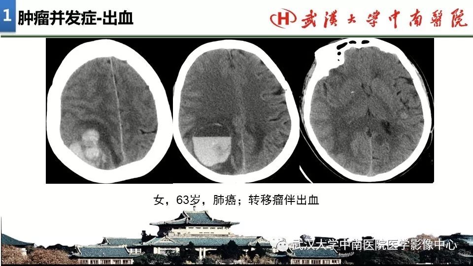 影像PPT - 【PPT】局灶性脑部病变影像诊断-6
