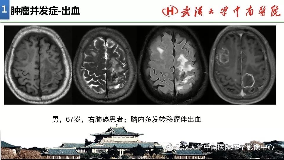 影像PPT - 【PPT】局灶性脑部病变影像诊断-7