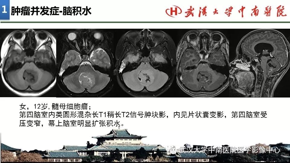 影像PPT - 【PPT】局灶性脑部病变影像诊断-8