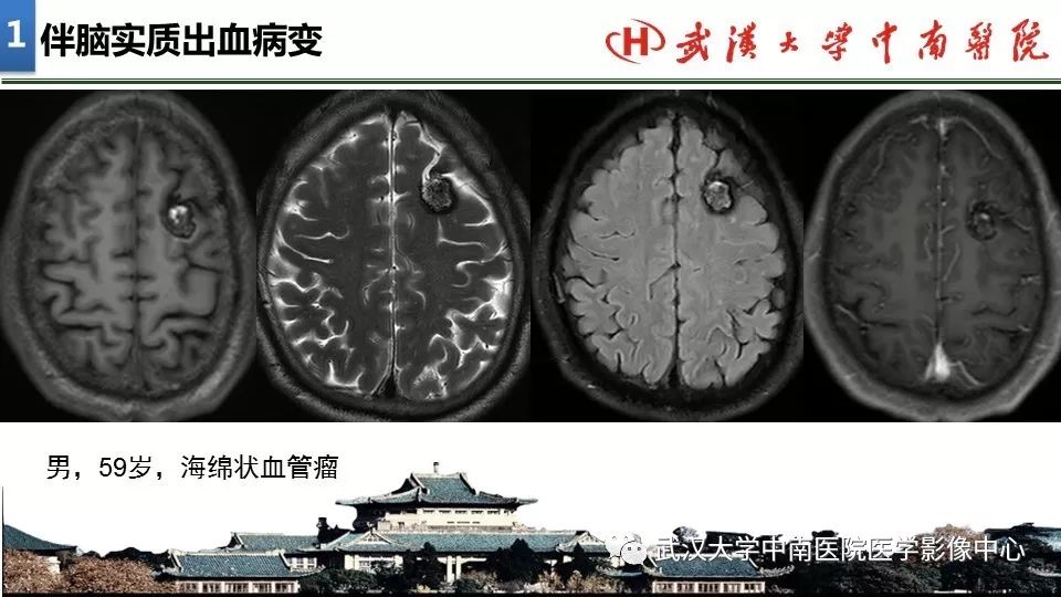 影像PPT - 【PPT】局灶性脑部病变影像诊断-10